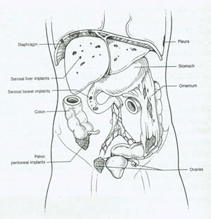 بيماريهاي تخمدان و لوله هاي رحمي چیست؟(1)